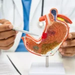 cáncer de estómago
